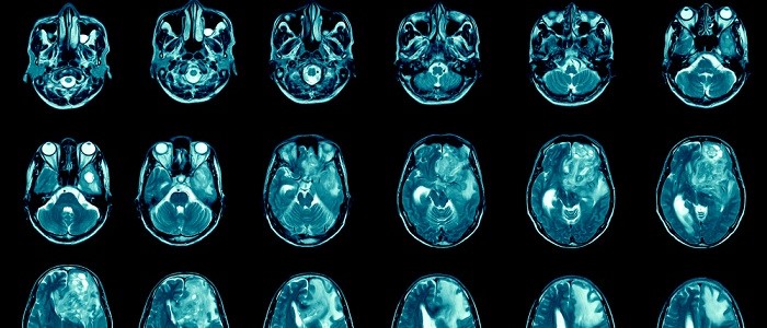 Multiple scans of gioblastoma cancer