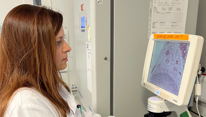A researcher in a white lab coat and blue gloves examines a tissue sample on a microscope in a laboratory. A monitor displays a magnified image of the biopsy sample, and lab equipment and notes are visible on the bench.