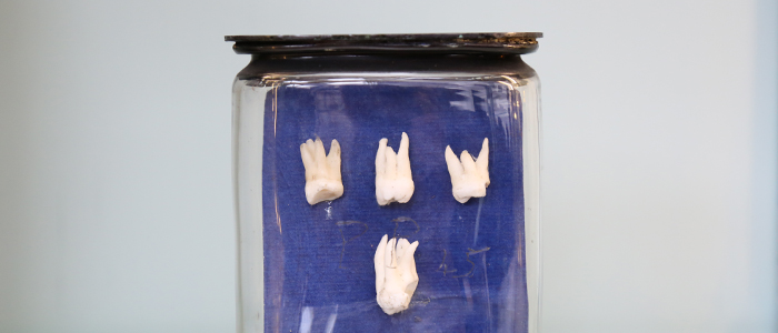Image of human Wisdom Teeth