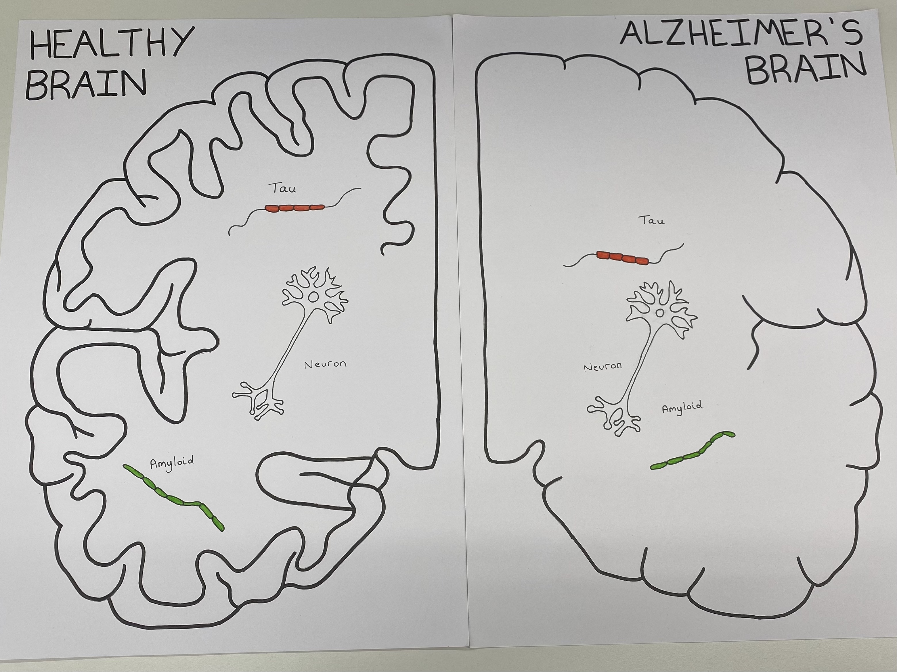 Outlines of healthy and Alzheimer's brains with tau, neurons and amyloid labelled