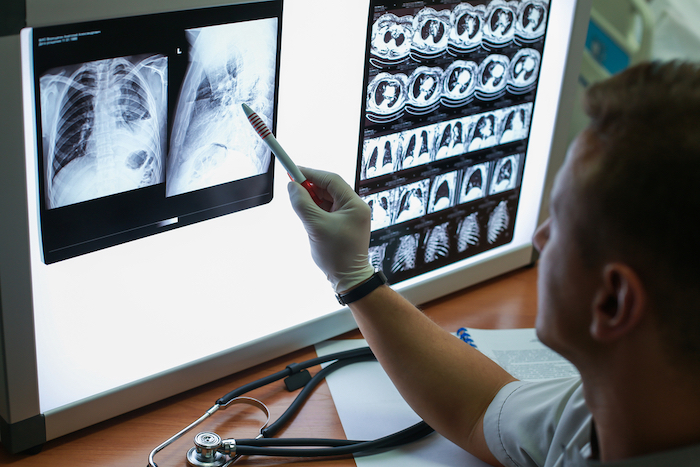 A doctor looking at the radiographs of a patient's lungs